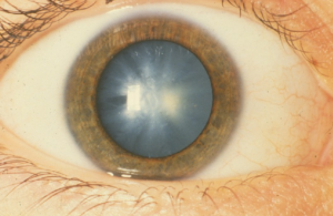 vision, cataracts surgery